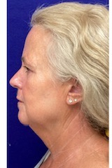 Neck Liposuction Before & After Patient #9208