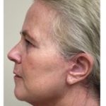 Revanesse Versa - Cheeks Before & After Patient #9208
