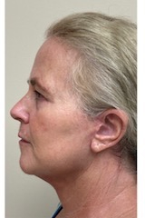 HourLift Before & After Patient #9208