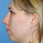 Y Lift Before & After Patient #9351