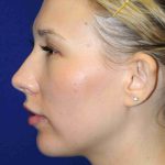 Y Lift Before & After Patient #9351
