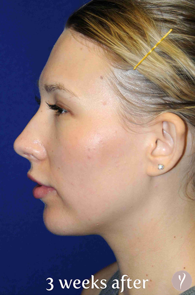 Y Lift Before & After Patient #9351