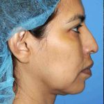 Y Lift Before & After Patient #9354