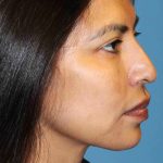 Y Lift Before & After Patient #9354