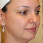 Y Lift Before & After Patient #9348