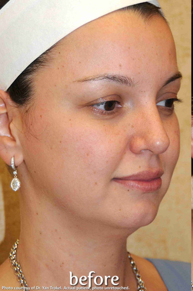Y Lift Before & After Patient #9348