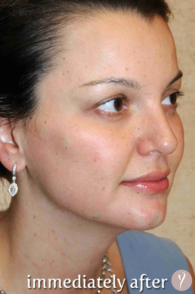 Y Lift Before & After Patient #9348
