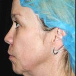 Y Lift Before & After Patient #9344