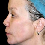 Y Lift Before & After Patient #9344
