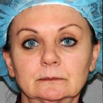 Y Lift Before & After Patient #9339