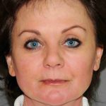 Y Lift Before & After Patient #9339