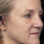 Thermage Before & After Patient #9360