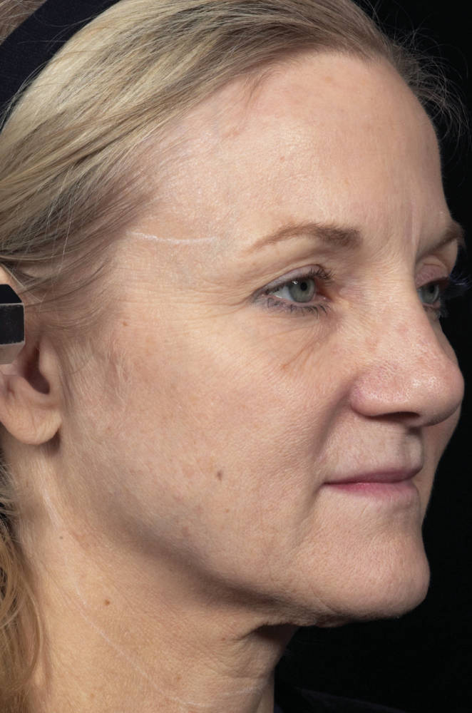 Thermage Before & After Patient #9360