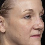 Thermage Before & After Patient #9360