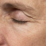 Thermage Before & After Patient #9369