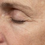 Thermage Before & After Patient #9369