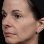 Thermage Before & After Patient #9370