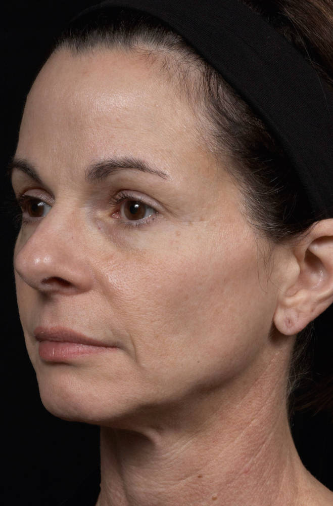 Thermage Before & After Patient #9370