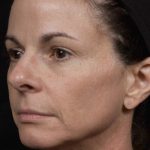 Thermage Before & After Patient #9370
