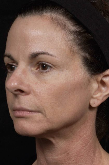Thermage Before & After Patient #9370