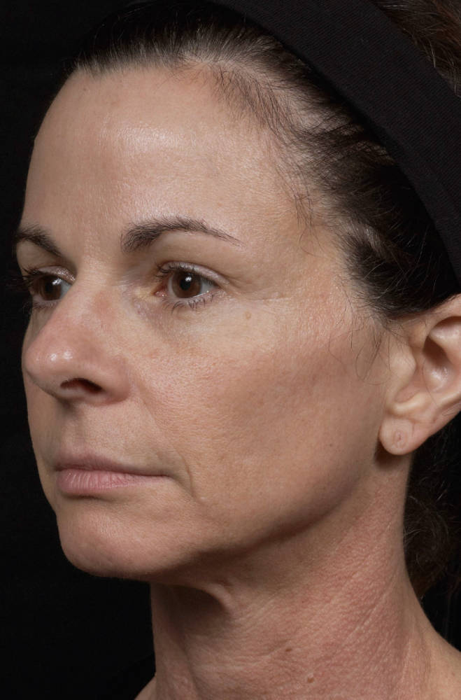 Thermage Before & After Patient #9370