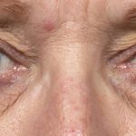 Thermage Before & After Patient #9373