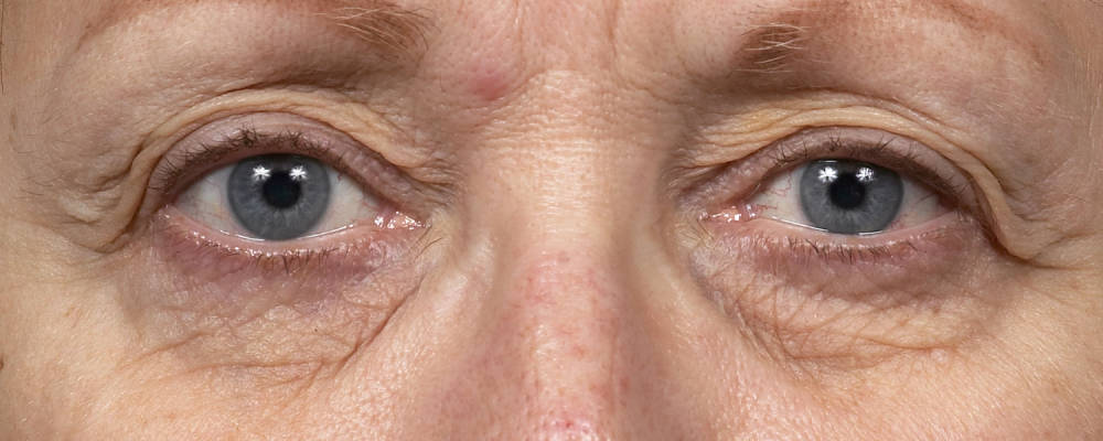 Thermage Before & After Patient #9373
