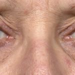 Thermage Before & After Patient #9373