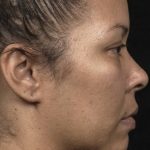 Thermage Before & After Patient #9376