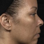 Thermage Before & After Patient #9376