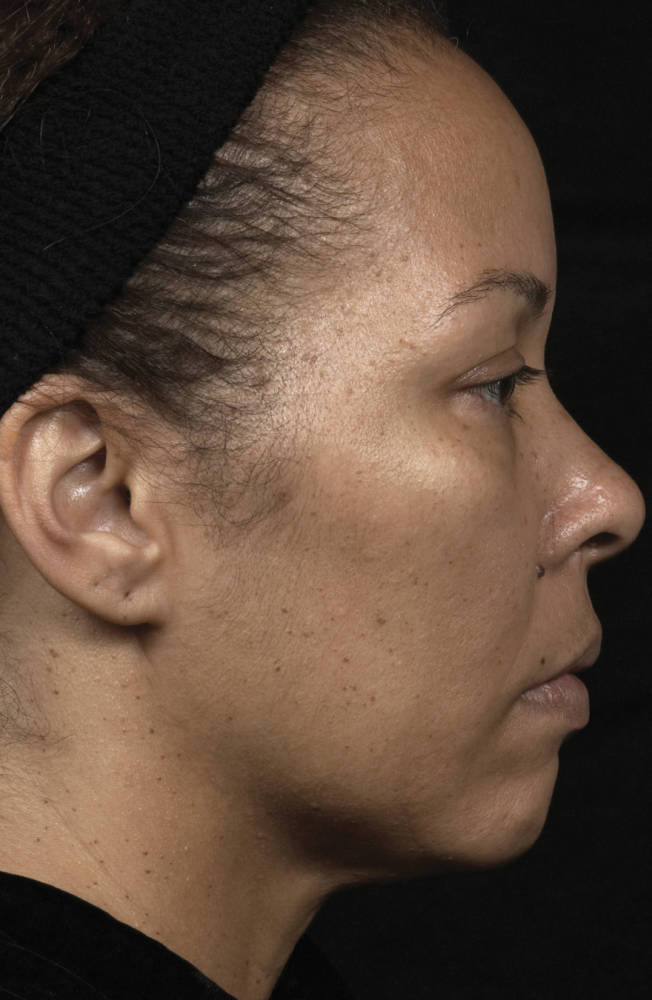 Thermage Before & After Patient #9376