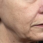 Thermage Before & After Patient #9379