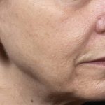 Thermage Before & After Patient #9379