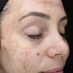 VI Peel Before & After Patient #9385