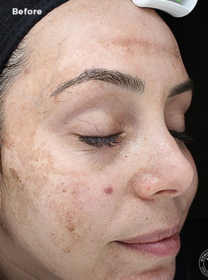VI Peel Before & After Patient #9385