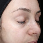 VI Peel Before & After Patient #9385