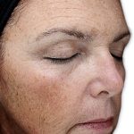 VI Peel Before & After Patient #9388