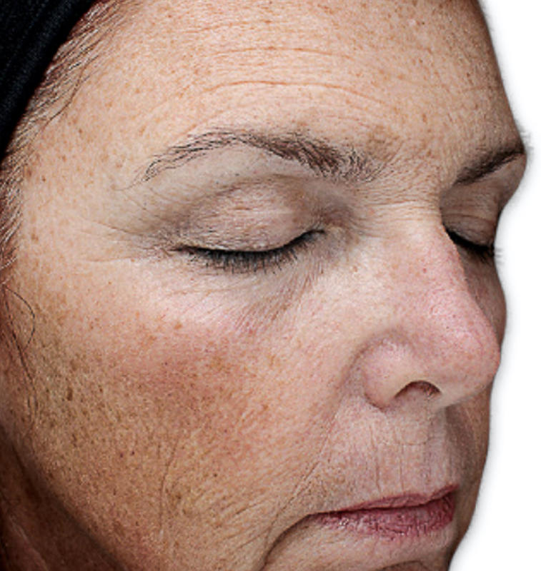 VI Peel Before & After Patient #9388