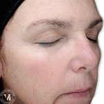 VI Peel Before & After Patient #9388
