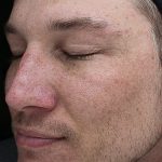VI Peel Before & After Patient #9391