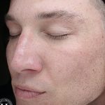VI Peel Before & After Patient #9391