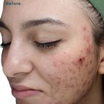VI Peel Before & After Patient #9394
