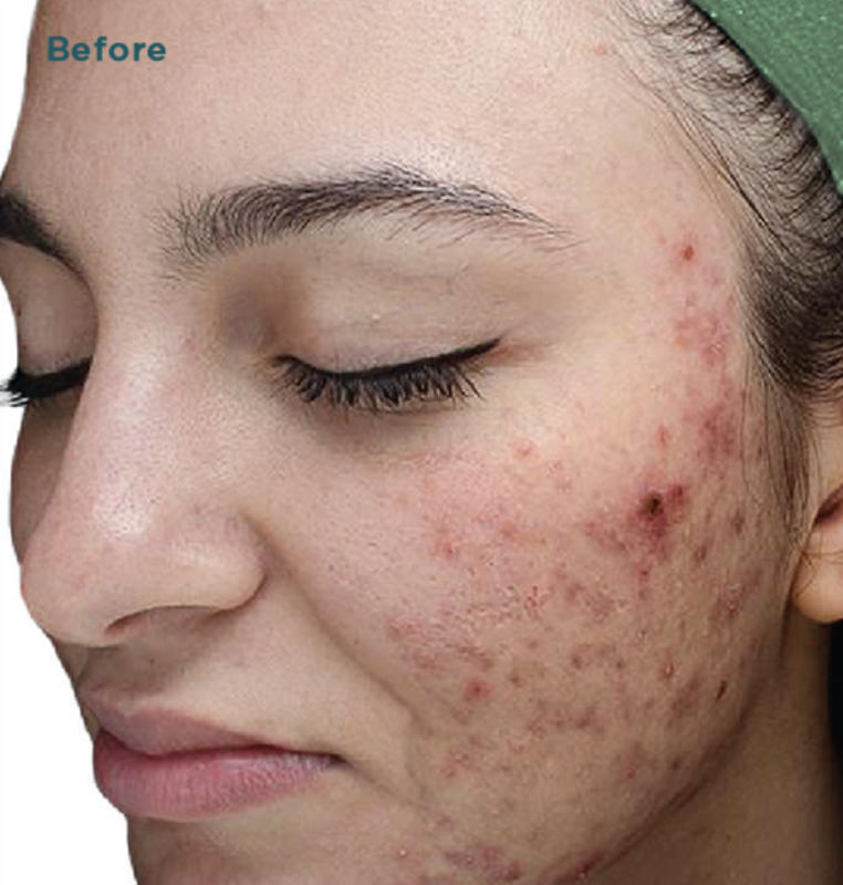 VI Peel Before & After Patient #9394