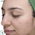 VI Peel Before & After Patient #9394