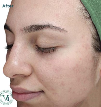 VI Peel Before & After Patient #9394