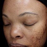 VI Peel Before & After Patient #9397