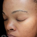 VI Peel Before & After Patient #9397
