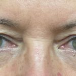 Blepharoplasty Before & After Patient #9251