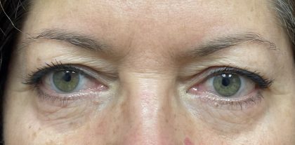 Blepharoplasty Before & After Patient #9251