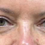 Blepharoplasty Before & After Patient #9251